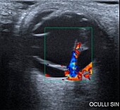 Detached retina, ultrasound scan