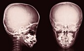 Normal skull, X-ray