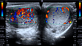 Orchitis testicle infection, ultrasound scan