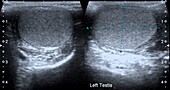 Testis, ultrasound scan