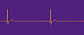 Complete heart block electrocardiogram, illustration