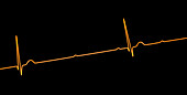 Complete heart block electrocardiogram, illustration