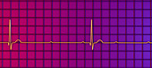 Complete heart block electrocardiogram, illustration