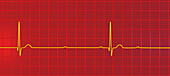 Complete heart block electrocardiogram, illustration