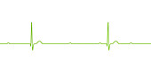 Complete heart block electrocardiogram, illustration