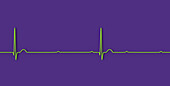 Complete heart block electrocardiogram, illustration