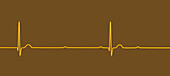 Complete heart block electrocardiogram, illustration