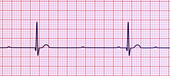 Complete heart block electrocardiogram, illustration