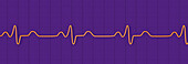 Bundle branch block electrocardiogram, illustration