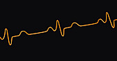 Bundle branch block electrocardiogram, illustration