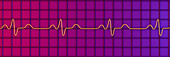 Bundle branch block electrocardiogram, illustration