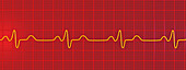 Bundle branch block electrocardiogram, illustration