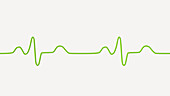 Bundle branch block electrocardiogram, illustration