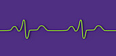 Bundle branch block electrocardiogram, illustration