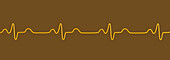 Bundle branch block electrocardiogram, illustration