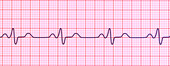 Bundle branch block electrocardiogram, illustration