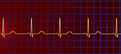 Long QT syndrome type 2 electrocardiogram, illustration