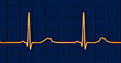 Long QT syndrome type 2 electrocardiogram, illustration