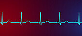 Long QT syndrome type 2 electrocardiogram, illustration