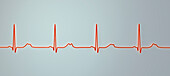 Long QT syndrome type 2 electrocardiogram, illustration