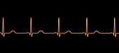 Long QT syndrome type 2 electrocardiogram, illustration