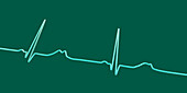 Long QT syndrome type 2 electrocardiogram, illustration