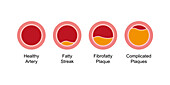 Atherosclerosis stages, illustration