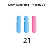 Trisomy 21 syndrome, illustration