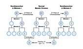 Trisomy 21 syndrome, illustration