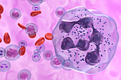 Hyper-segmented neutrophil in WHIM syndrome, illustration