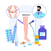 Knee joint arthroscopy, illustration