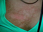 Terra firme-forme dermatosis after alcohol swab