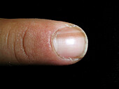 Discoloured nail