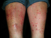 Pustular psoriasis