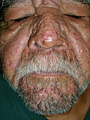 Rhinophyma after surgeries