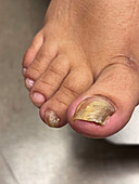 Fungal nail infection