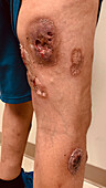 Pyoderma gangrenosum