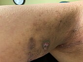 Pyoderma gangrenosum