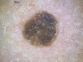 Seborrheic keratosis, dermoscopy