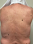 Seborrheic keratosis