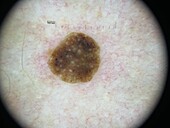 Seborrheic keratosis, dermoscopy