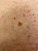 Seborrheic keratosis