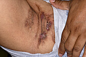 Hidradenitis suppurativa