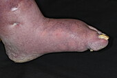 Congenital absence of toes in male patient