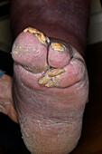 Congenital absence of toes in male patient