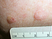 Seborrheic keratosis