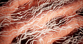 Heart tissue affected by amyloid light chain amyloidosis, illustration