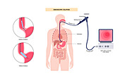 Endoscopic pneumatic dilation, illustration