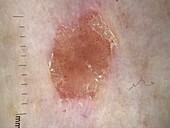 Seborrheic keratosis, dermoscopy