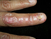 Linear lichen planus